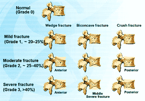 Vertebral Fractures | International Osteoporosis Foundation