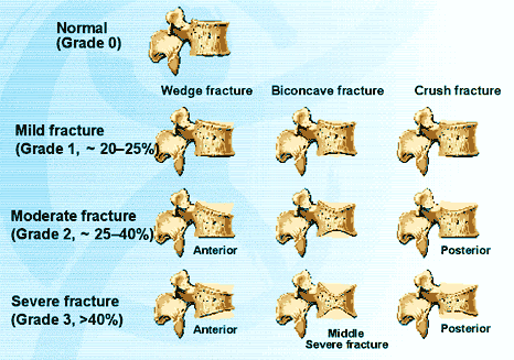 What Are Vertebral Compression Fractures? - StoryMD